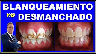 BLANQUEAMIENTO DENTAL DESMANCHADO TECNICA COMBINADA [upl. by Acirret852]