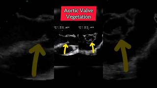 Aortic Valve vegetation on Echocardiogram Echocardiography for Beginners heart [upl. by Cadmarr]