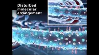 Stem Cell Therapy After Spinal Cord Injury [upl. by Bethina]