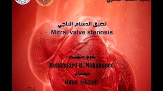 تضيق الدسام التاجي Mitral Valve Stenosis  جامعة دمشق  SMV [upl. by Ycak]