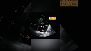 Atrial Septal aneurysm shorts echocardiography anatomy [upl. by Amabil]