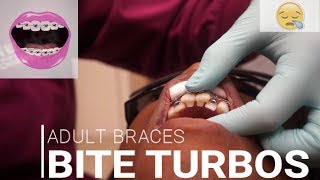 ADULT BRACES  Bite Turbos  Session 2 [upl. by Adrial471]