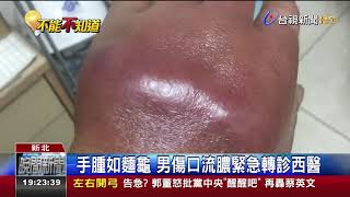 搬重物手腫男針灸惡化蜂窩性組織炎 [upl. by Eikcir]