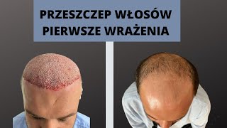 Przeszczep włosów w Turcji  pierwsze wrażenia [upl. by Ecnerrot]