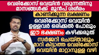 വെരിക്കോസ് വെയിൻ ഉള്ളവർ ഒരിക്കൽ പോലും ഈ ഭക്ഷണം കഴിക്കരുത്  Varicose veins Malayalam [upl. by Eillod]