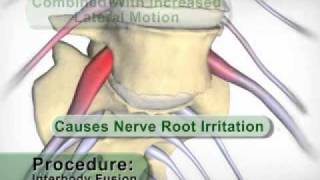 Anterior Lumbar Interbody Fusion [upl. by Thorn115]