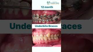 Underbite Braces shorts braces dentist [upl. by Dimmick]