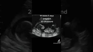 2D Pregnancy Ultrasound at 14 Weeks 5 Days [upl. by Geilich]