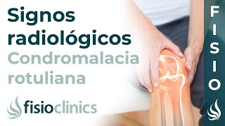 Condromalacia rotuliana Signos radiológicos  FisioClinics Palma de Mallorca [upl. by Cogen]