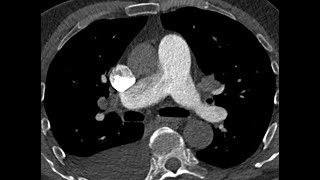 Patent ductus arteriosus may mimics Pulmonary Embolism  CTPA [upl. by Nosyrb352]