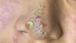 Big Cystic Acne Blackheads Extraction Blackheads amp Milia Whiteheads Removal Pimple Popping  162 [upl. by Revilo954]