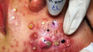 🤮puntos negro en la nariz extracción🔞🤢Black head [upl. by Platus]