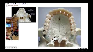 02 maxillary palatal infiltration anesthetic technique [upl. by Riamo597]