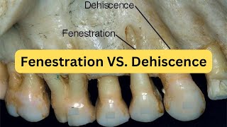 Difference between fenestration and dehiscence with mnemonic [upl. by Olmstead]