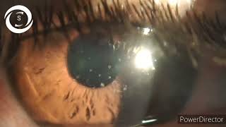 Adenoviral punctate keratitis [upl. by Gae]