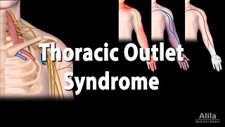 Thoracic Outlet Syndrome TOS Animation [upl. by Brag261]