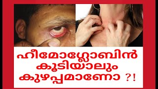 Is there any problem if hemoglobin is high  Erythrocytosis  Polycythemia Malayalam [upl. by English]