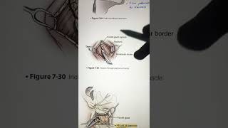 “TRANSPAROTID APPROACH” FOR TMJ SURGERY tmj oralsurgery maxillofacialsurgery neetmds [upl. by Snyder]