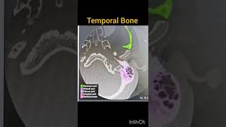 CT temporal Bone anatomy mastoid temporalbone [upl. by Toffic]