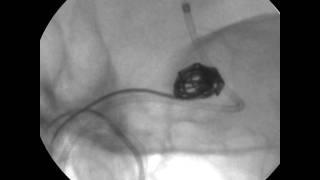 Use of the MicroAngiographic Fluoroscope for Coiling of Intracranial Aneurysms Video 2 [upl. by Eilyab]