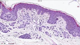 Compound Melanocytic Nevus  Histopathology [upl. by Dar]