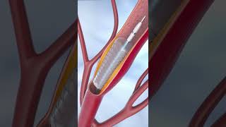 coronary angioplasty and stent insertion 3danimationsurgery anatomy medicalanimation viralvideo [upl. by Euh]