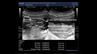 Twin pregnancy with one Blighted ovum and the other with Missed abortion [upl. by Aniala716]