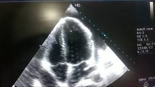 CARDIAC TAMPONADE ECHO APICAL FOUR CHAMBER VIEW [upl. by Suilenrac]