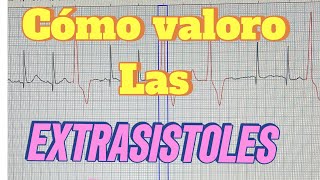 Extrasistoles Video en vivo [upl. by Rramo]