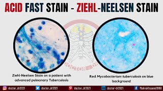 Acid Fast Stain Technique  ZiehlNeelsen Stain  Microbiology Laboratory Techniques [upl. by Ransom]