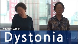 DystoniaCervical dystonia사경증 치료사례  근긴장이상증 [upl. by Schreibman468]