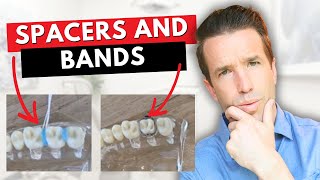 Most Painful Part of Braces  Spacers Bands [upl. by Frederique]