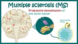 Multiple sclerosis  Types of Multiple Sclerosis  Causes symptoms diagnosis treatment pathology [upl. by Anema]