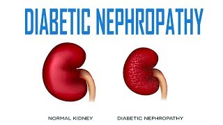 Diabetic Nephropathy  Pathology Causes Symptoms Diagnosis Treatment [upl. by Mehsah]