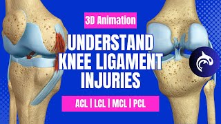 Understand Knee Ligament Injuries ACL PCL MCL LCL  3D animation [upl. by Bakerman]