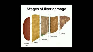 Stages of Liver Damage [upl. by Effy594]