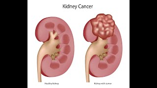 FDA approves nivolumab plus cabozantinib for advanced renal cell carcinoma [upl. by Releyks]