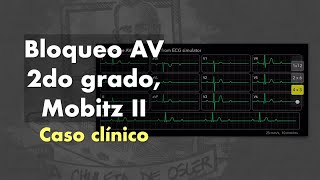 Caso clínico Bloqueo AV de 2do grado Mobitz II [upl. by Torrin]