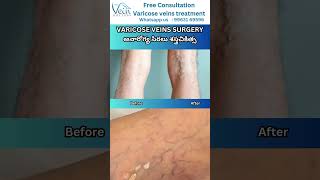 Varicose Veins in surgery and Seeking Solutions varicoseveins telugu hospital symptoms [upl. by Waring]