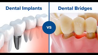 Which is better a dental bridge or implant [upl. by Eiramadnil]