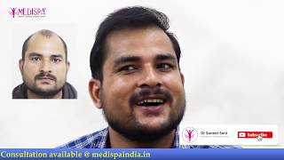 SUPER NATURAL HAIRLINE in Level 6 Baldness Hair Transplant at Medispa Dr Suneet INDIA Jaipur Delhi [upl. by Ahseinar]