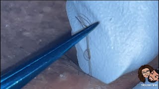 Ingrown Hair Removal Ep28 [upl. by Aura907]