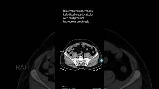 Bilateral renal concretionsLeft distal ureteric calculus with mild proximal hydroureteronephrosis [upl. by Belen439]