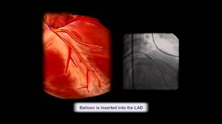 Cardiac Tamponade from PCI resulting in death due to failure [upl. by Assenej228]