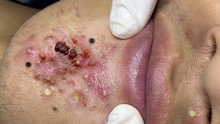 Big Cystic Acne Blackheads Extraction Blackheads amp Milia Whiteheads Removal Pimple Popping  65762 [upl. by Dibru]