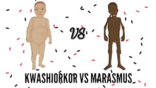 SAM  Severe Acute Malnutrition  Kwashiorkor VS Marasmus [upl. by Maghutte38]