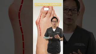 Traditional vs Minimally Invasive Bunion Surgery  MCAShorts [upl. by Swor]