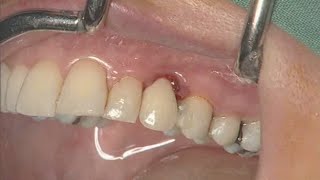 NobelActive clinical case immediate implant placement  Eric Rompen [upl. by Herson]