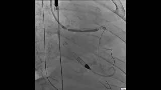 Shockwave Intravascular Lithotripsy 35 mm × 40 mm Shockwave Balloon in the Distal LMCA to LAD [upl. by Gass]