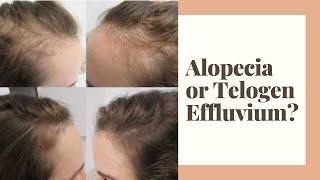 Alopecia or Telogen Effluvium [upl. by Acissj]